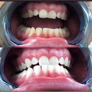 Atown Grillz Teeth Whitening